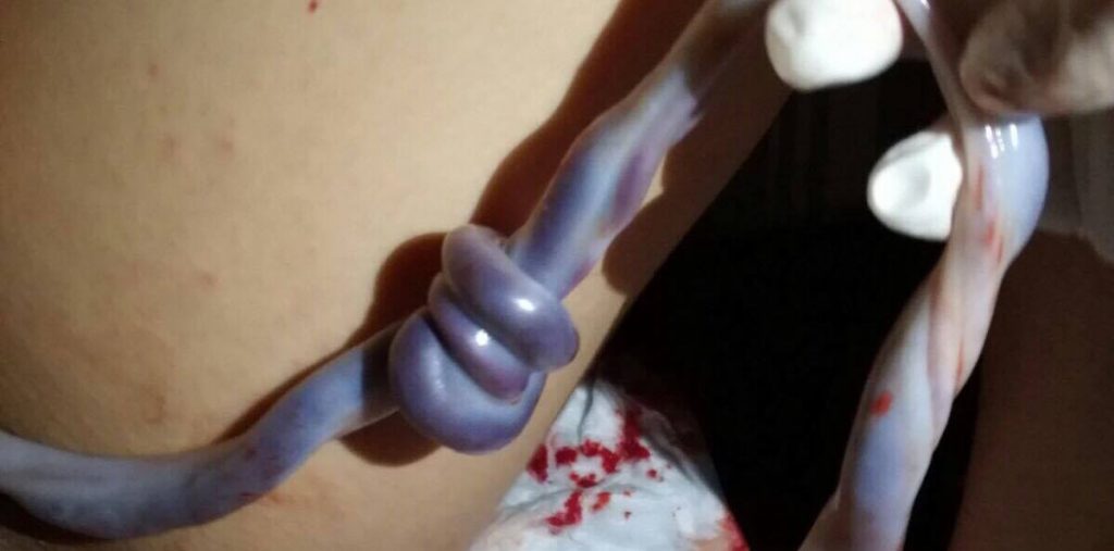 uzel na pupeční šňůře