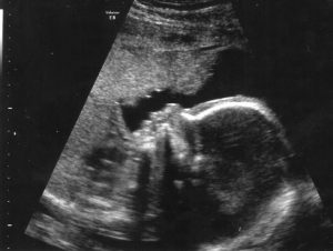 Zázrak jménem VBA2C (spontánní porod po dvou sekcích)